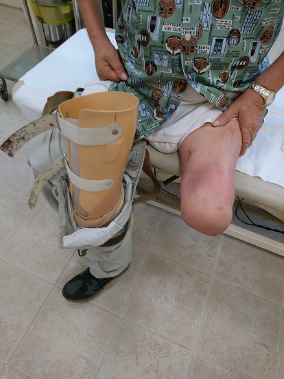 Pri bolniku smo reševali življenje z amputacijo skozi koleno